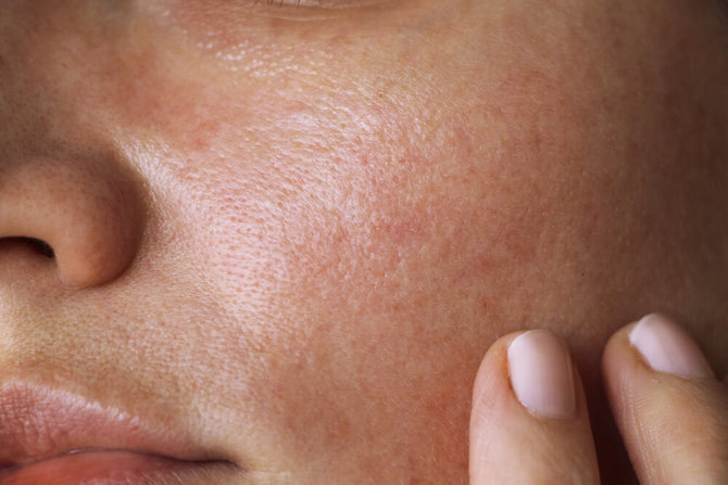 acne scar
