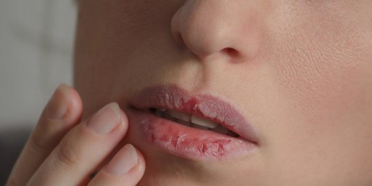 6 Cara Cegah Bibir Kering saat Menjalani Puasa Ramadan