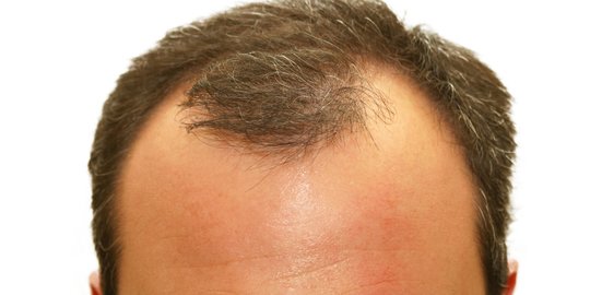 9-cara-menumbuhkan-rambut-botak-dengan-bahan-alami-efektif-dan-mudah-dilakukan-or-merdeka-com