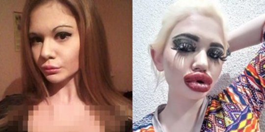Jadi Sorotan, Ini 6 Potret Wanita Berbibir Paling Besar Pernah Injeksi 20 Kali