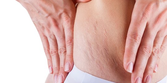 15 Cara Menghilangkan Stretch Mark di Bokong dengan Bahan Alami, Mudah dan Ampuh