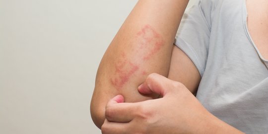 6 Cara Mengobati Dermatitis Kontak, Efektif Kurangi Gejala