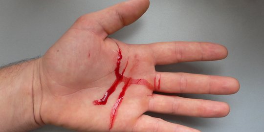 7 Gejala Tetanus yang Perlu Diwaspadai, Kenali Cara Mengatasinya