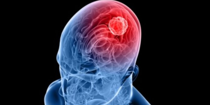 10 Gejala Tumor Otak Ketahui Penyebab Dan Cara Mengatasinya