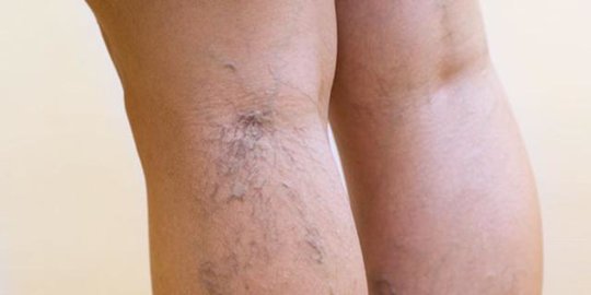 5 Bahan Alami yang Mampu Mengatasi dan Mencegah Munculnya Varises