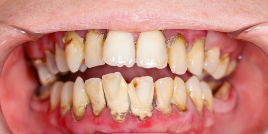 6 Penyebab Karang Gigi Menumpuk dan Sulit Hilang, Jangan Disepelekan