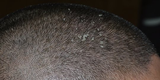 dan rambut berminyak rev4