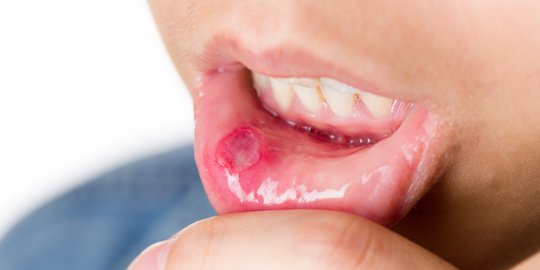 Kekurangan vitamin c dapat menyebabkan rongga mulut terkena