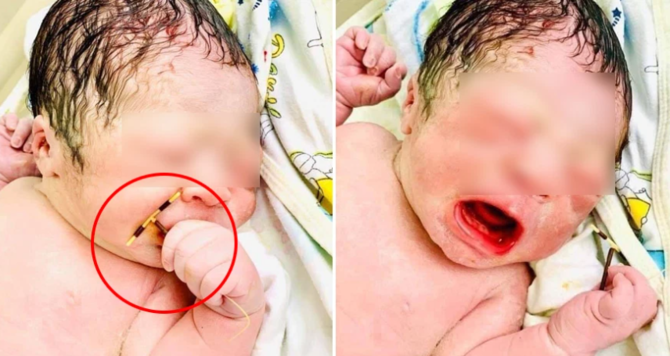 unik bayi ini lahir 039membawa039 iud dan fotonya jadi viral