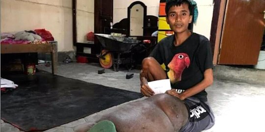 Kisah Pilu Pasien Kaki Gajah di Bojonegoro, Dapat Penanganan Medis Setelah 23 Tahun