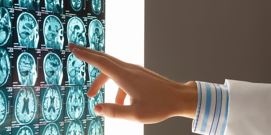 Gejala Kanker Otak yang Perlu Diwaspadai, Ketahui Cara Mencegahnya