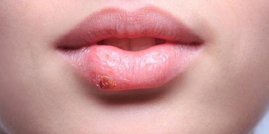 5 Cara Menyembuhkan Herpes Secara Alami, Hindari Makanan Berikut