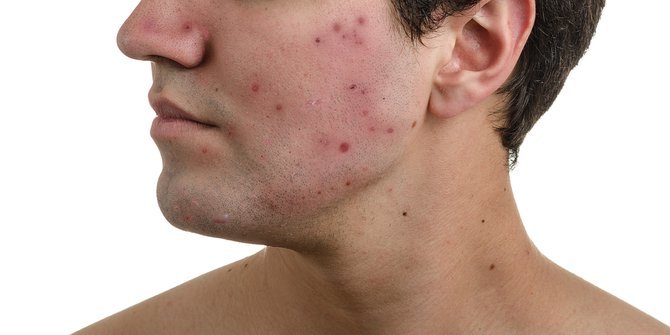 7 ways to get rid of acne scars or pockmarks with easy natural ingredients and a