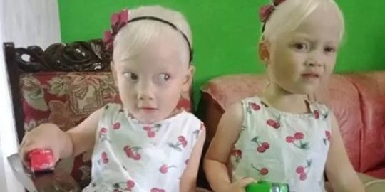 Viral Gadis Kembar Albino Asal Wonogiri, Orang Tuanya Sering Dikira Pembantu
