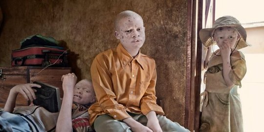 Albino Adalah Kelainan Produksi Pigmen Kulit, Ketahui Gejala dan Penyebabnya