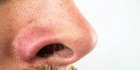 6 Cara Menghilangkan Komedo Hitam di Hidung Secara Alami, Ketahui Penyebabnya