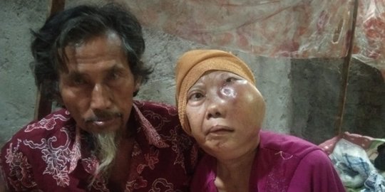Perempuan Ini Kena Tumor di Pipi hingga Tutupi Mata, Tak Sanggup Berobat