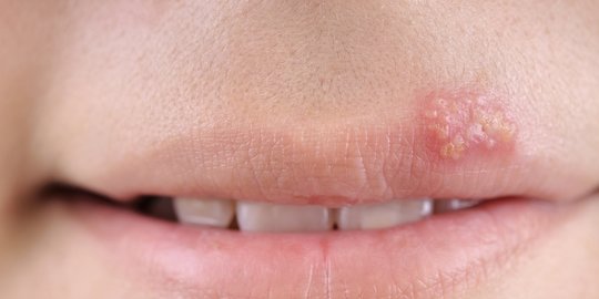 6 Gejala Herpes yang Perlu Diwaspadai, Begini Cara Mengatasinya