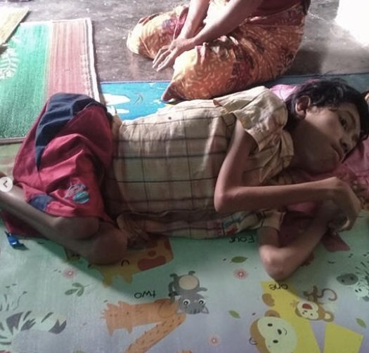 kisah bocah badan tinggal tulang idap polio selama 9 tahun