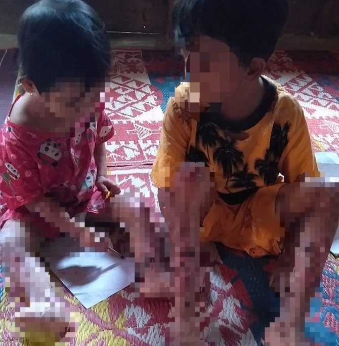 dua anaknya idap penyakit kulit tak kunjung sembuh curhatan ibu ini bikin pilu