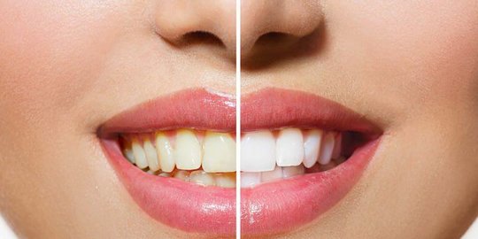 10 Cara Menghilangkan Plak Gigi Membandel, Tanpa Harus Pergi ke Dokter