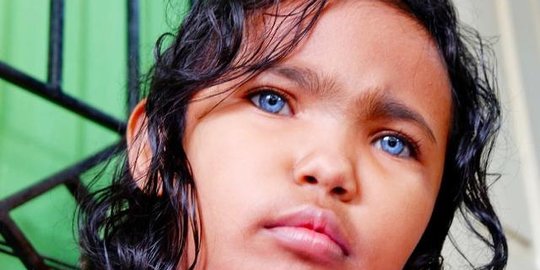 Viral Gadis Kecil Asal Pekanbaru Punya Mata Biru, Ternyata Ini Penyebabnya