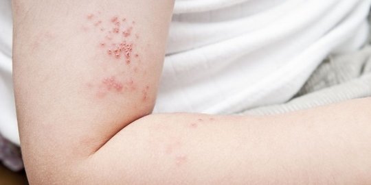 Penyebab Herpes Zoster yang Harus Diwaspadai, Berikut Gejala dan Cara Mengatasinya