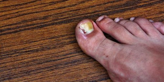 5 Cara Sederhana untuk Mengatasi Masalah Kuku Cantengan yang Sangat Mengganggu