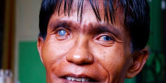 Cerita Satu Keluarga di Sumbar Bermata Biru seperti Orang Eropa