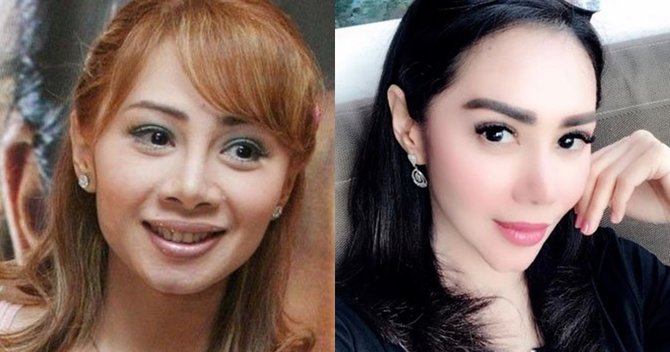 artis indonesia operasi hidung