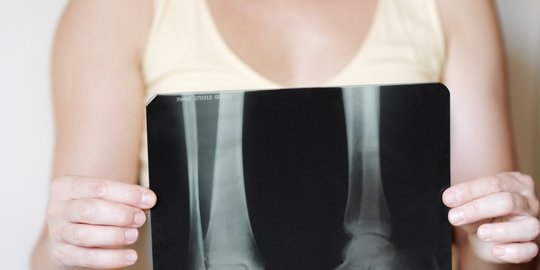 Usia dan Jenis Kelamin Berperan Terhadap Munculnya Risiko Osteoporosis