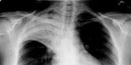 Bedakan Pneumonia karena Covid-19 atau Bakteri dengan Swab Test