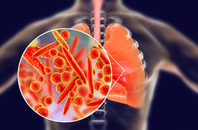 3 penyebab pneumonia dan gejalanya