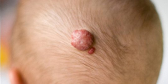 Hemangioma Adalah Benjolan Non Kanker di Tubuh, Kenali Tanda dan Cara Mengobatinya