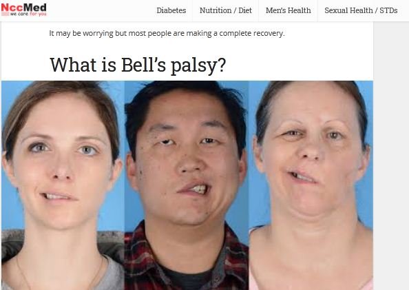Bells palsy adalah