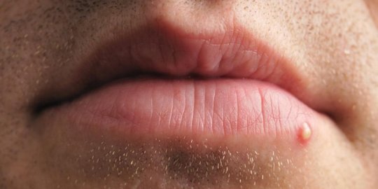 masalah jerawat di bibir
