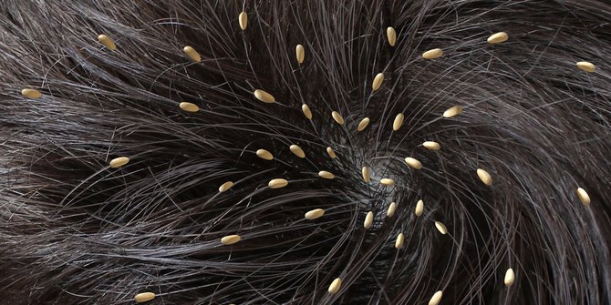 Penyebab Kutu Rambut, Gejala, dan Bagaimana Cara Mencegahnya