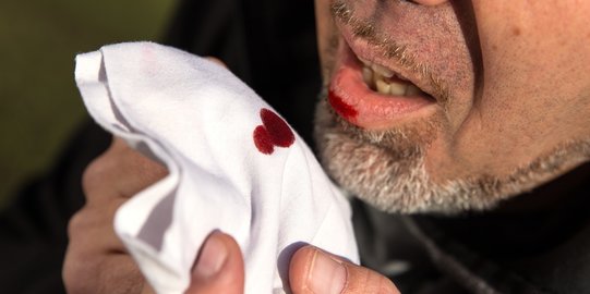 Penyebab Muntah Darah yang Sering Terjadi, Ketahui Gejala dan Cara Mengatasinya