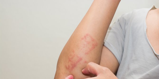 Mengenal Penyebab Dermatitis Ketahui Gejala Dan Pencegahannya Halaman Merdeka Com