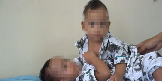 Bayi Kembar Siam Adam-Aris Jalani Operasi Pemisahan di RSUP H Adam Malik Besok