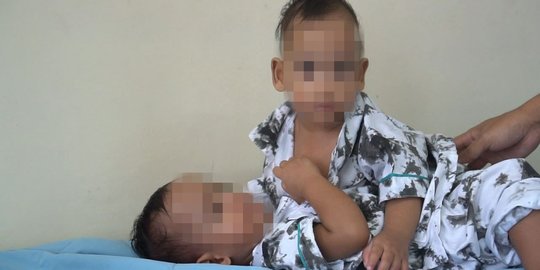 Bayi Kembar Siam Asal Sumut Berhasil Dipisahkan, Begini Kondisinya Sekarang