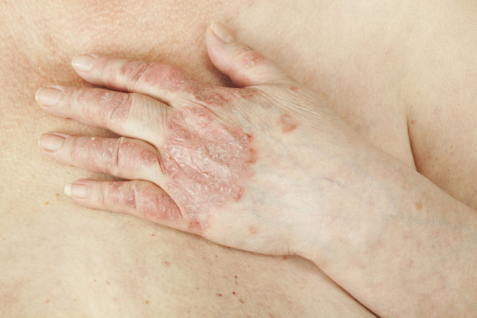 ilustrasi psoriasis