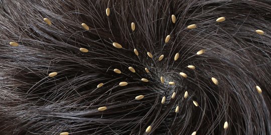 7 Cara Menghilangkan Telur Kutu pada Rambut, Ampuh Banget