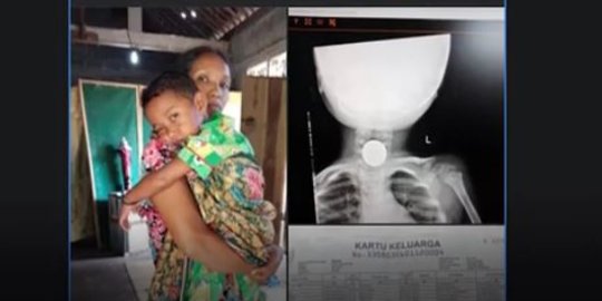Didatangi Wagub Jateng, Begini Reaksi Balita yang Telan Koin di Magelang