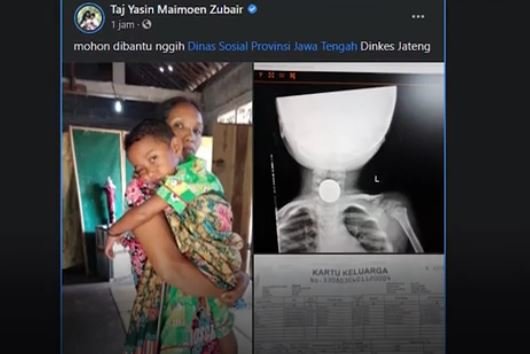 bocah tiga tahun di magelang telan koin