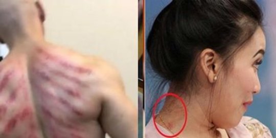 Sukses dalam Dunia Karier, Deretan Artis Ini Masih Suka Kerokan Jika Tak Enak Badan