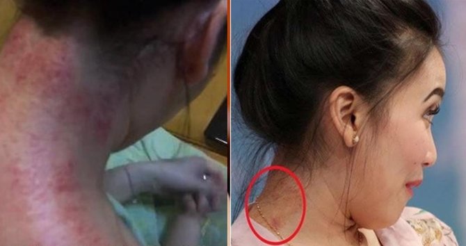 deretan artis ini masih suka kerokan jika tak enak badan