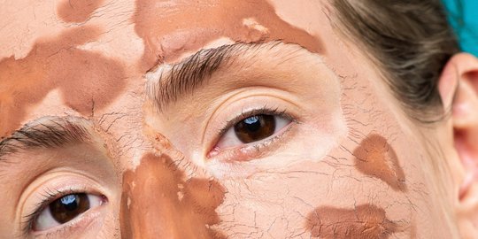 10 Manfaat Clay Mask untuk Kesehatan Kulit, Atasi Jerawat hingga Komedo Berlebih