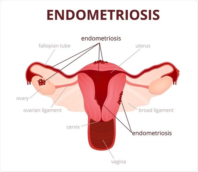 Oleh disebabkan penyakit endometriosis 10 Penyakit