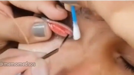 viral mata pria kemasukan lintah ngeri banget sampai diambil pakai pinset